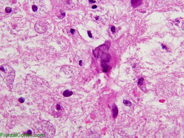 Progressive multifocal leukoencephalopathy, infected astrocyte, H&E stain X 600